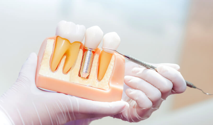 インプラント模型図