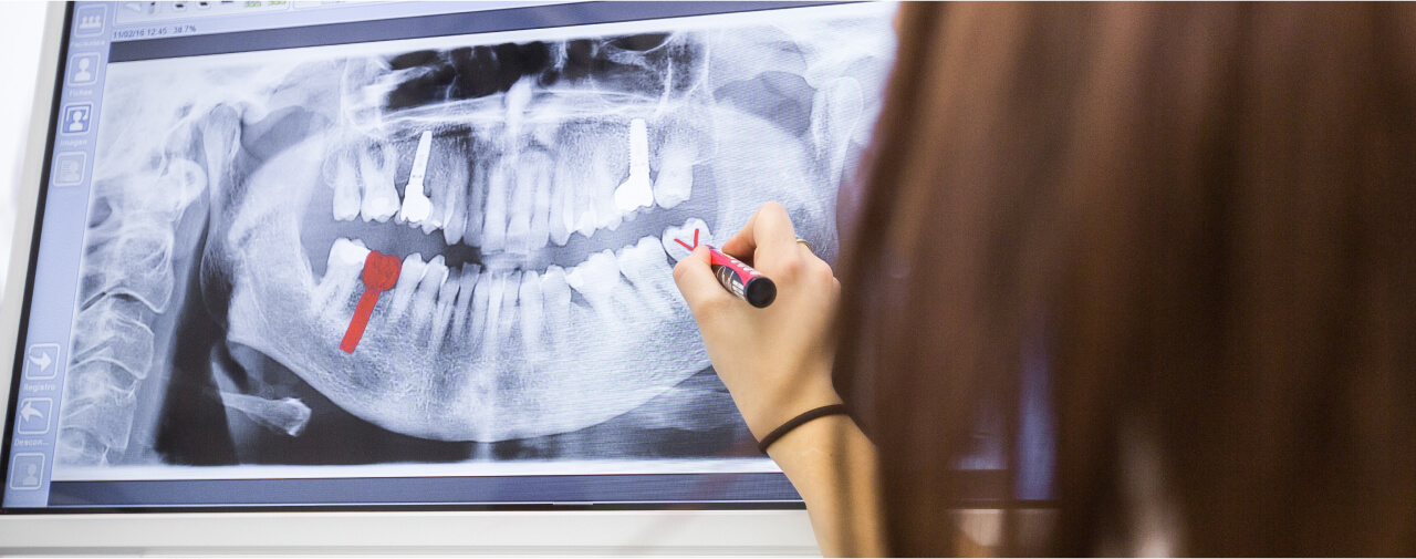 歯科医がデジタルレントゲン画像を確認し、インプラントや治療箇所をマークして説明している場面