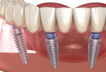 インプラント治療の構造を示す図。下顎に埋め込まれたインプラント体と人工歯の連結部分を説明するイラスト
