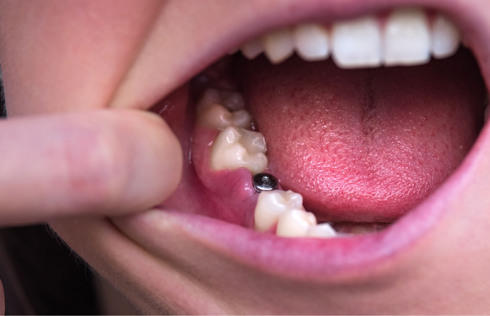 インプラントを埋入した口腔写真