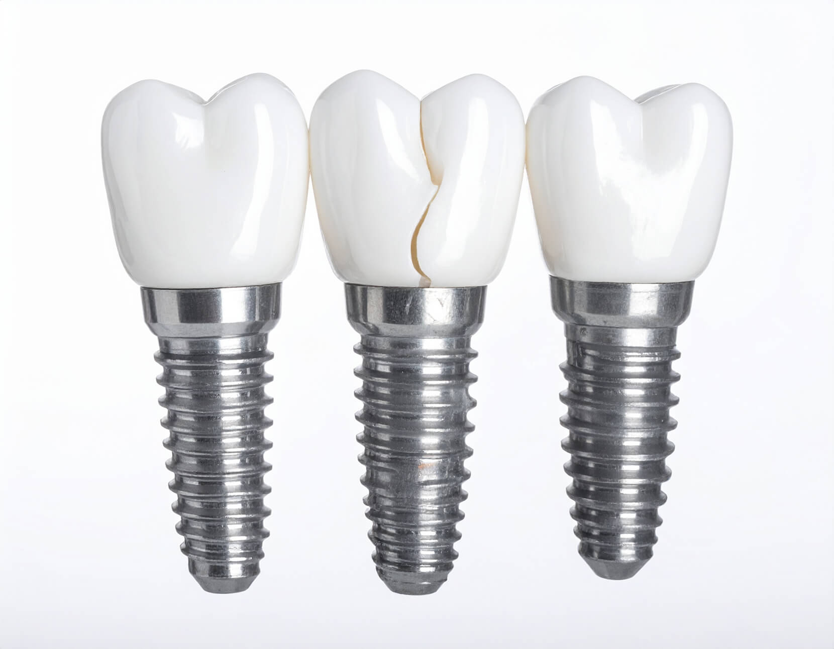 人工歯の部分が破損したインプラント写真