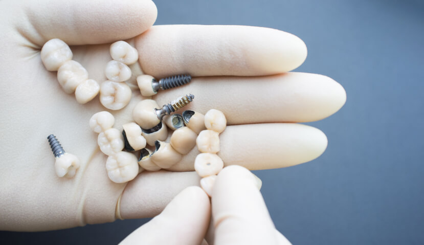 様々な種類のインプラント