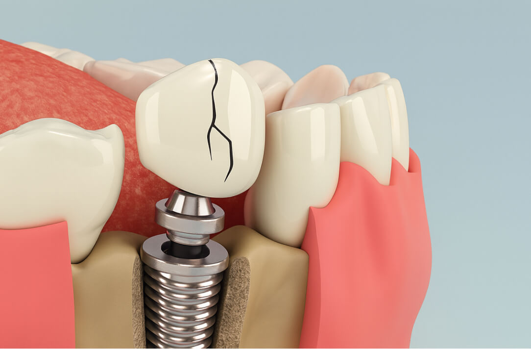 上部構造（被せ物）の破損