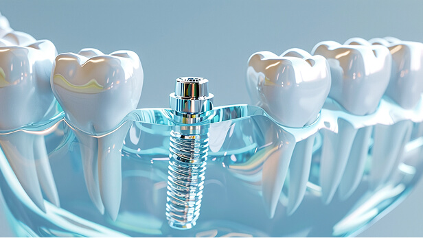 インプラント体の3DCG図