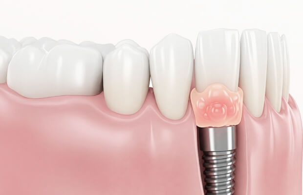 細菌感染(インプラント周囲炎)