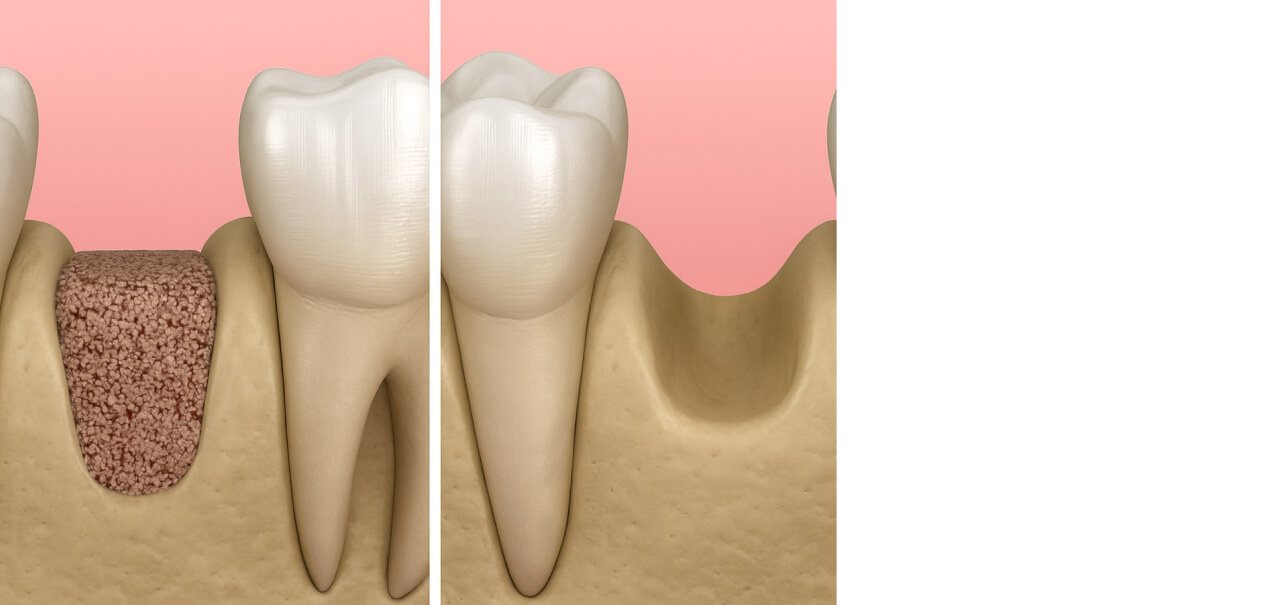 骨造成のビフォーアフター