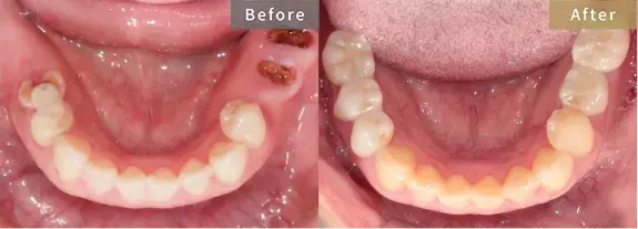 症例1 臼歯(奥歯)を失い、義歯回避を希望された患者様