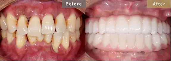 症例2 歯の動揺と咬合回復を希望された患者様