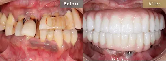 症例3 歯列不正と咬合不良により入れ歯回避を希望された患者様