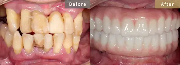 症例4 重度の歯の動揺と入れ歯回避を希望された患者様