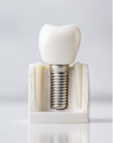 インプラント体