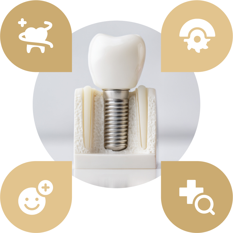 インプラントの図解