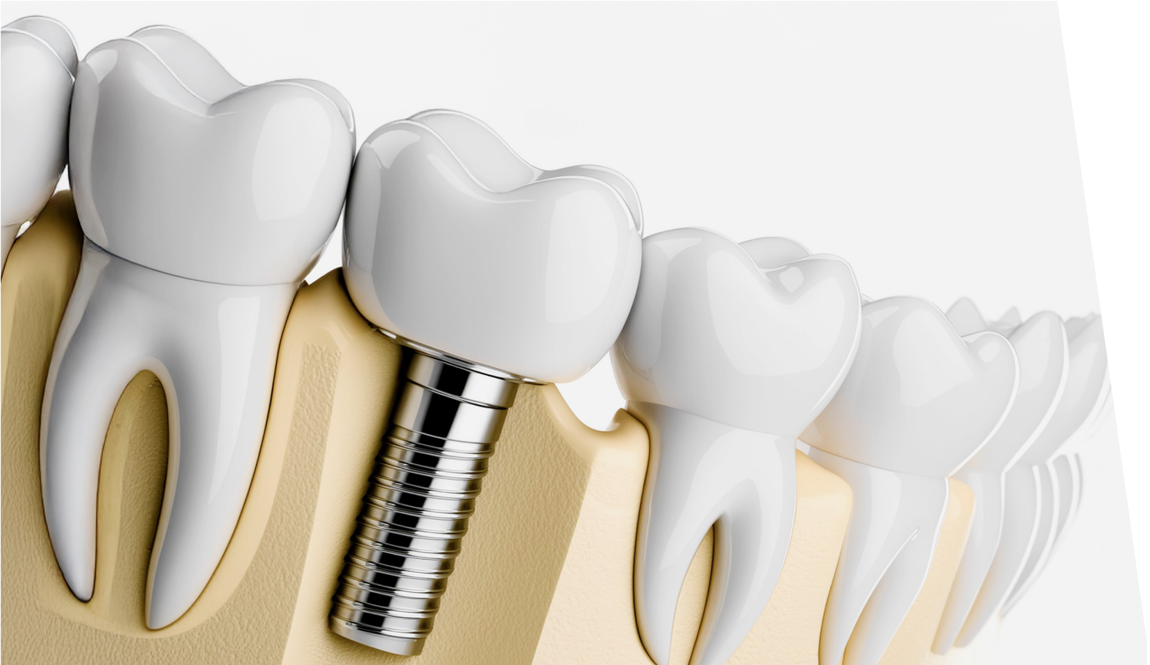 インプラント埋入写真