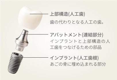 インプラント構造の写真と解説