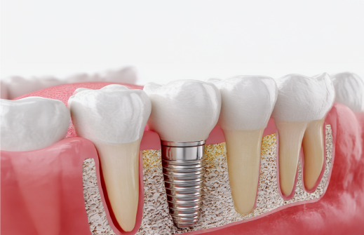 インプラント解説