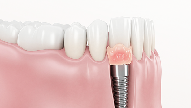 インプラント周囲炎の画像