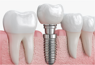 インプラントのイメージ