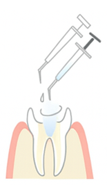 根管の洗浄と消毒