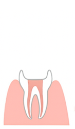根管に薬を充填