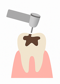 虫歯の除去
必要に応じて麻酔をします。