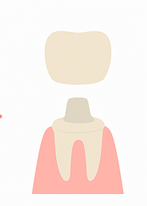 仮着or仮歯詰め物・被せ物の完成まで1～2週間程度待ちます。