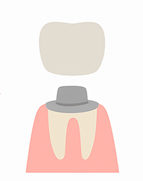 詰め物・被せ物を装着