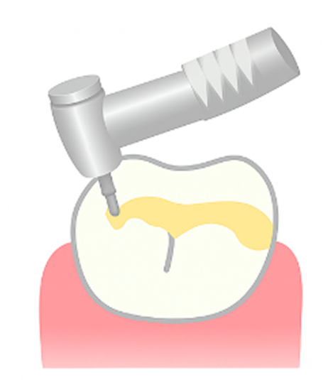 プラスチックを詰める