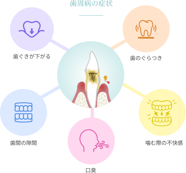 図解：歯周病の症状