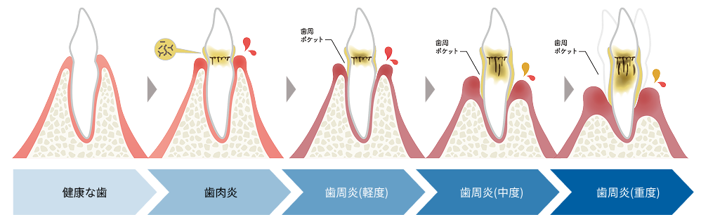 イラストで見る歯周病の進行