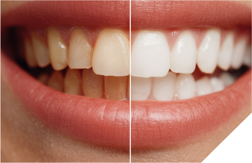 パウダークリーニング