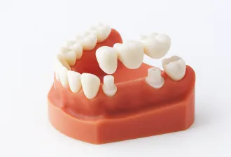 歯を失った部分を両隣の歯で支えるブリッジ治療の構造を示す歯科模型