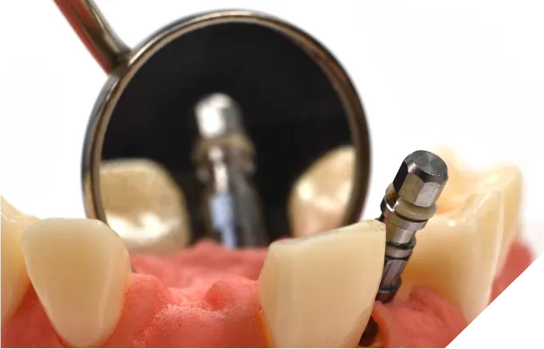 インプラント治療後のチェック