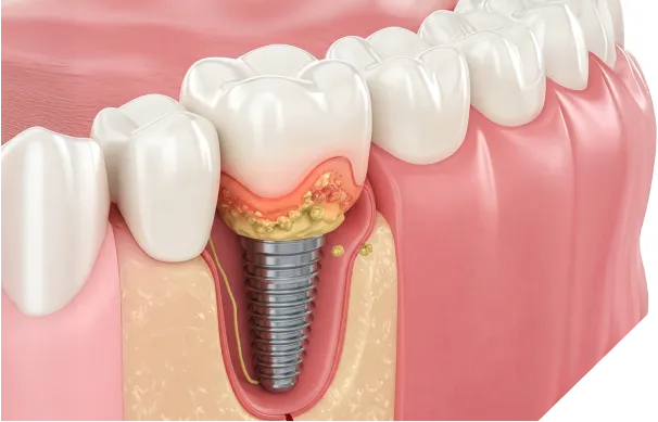 インプラント周囲炎