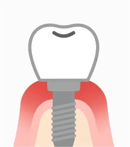 インプラントイラスト