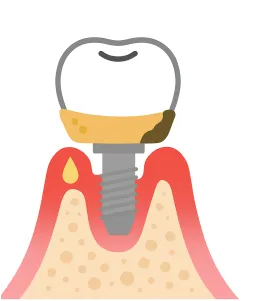 インプラント周囲炎のイラスト