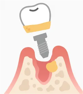 インプラント周囲炎により歯が抜けてしまったイラスト