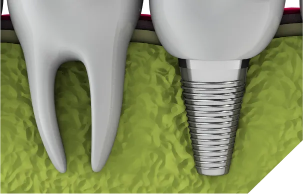 歯ぐきが黒ずんでいるインプラント図