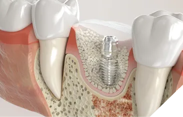 骨造成後にインプラント埋入