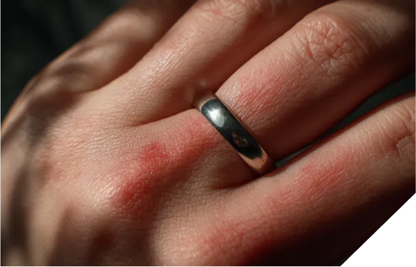 金属アレルギーの症状が出ている手