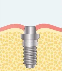 GBRを先に行う場合のステップ02イラスト