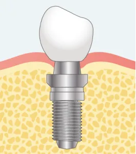 GBRを先に行う場合のステップ03イラスト