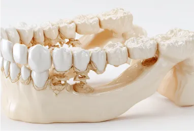 顎の骨を1/3以上失った画像